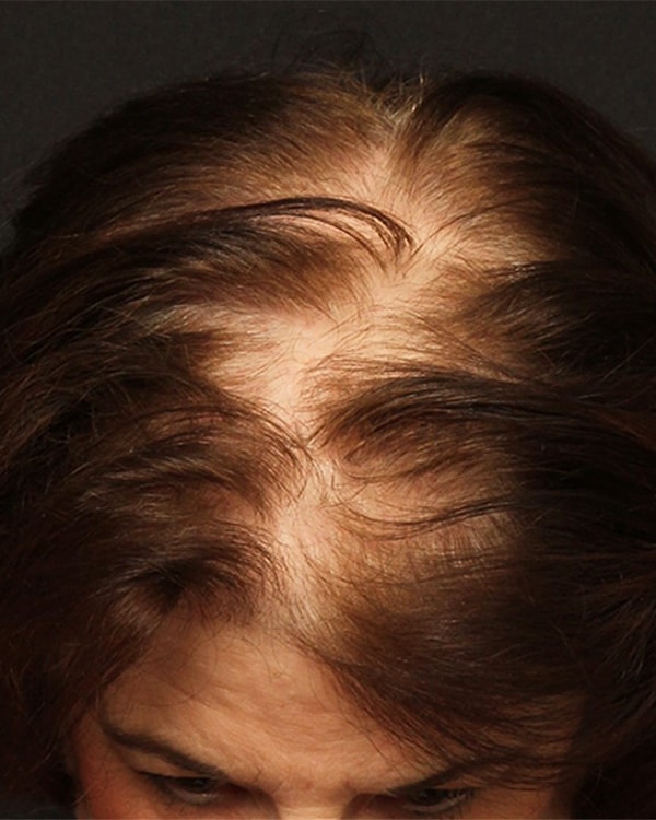 NeoGraft® Hair-Transplantation for Women | West End Hair Center