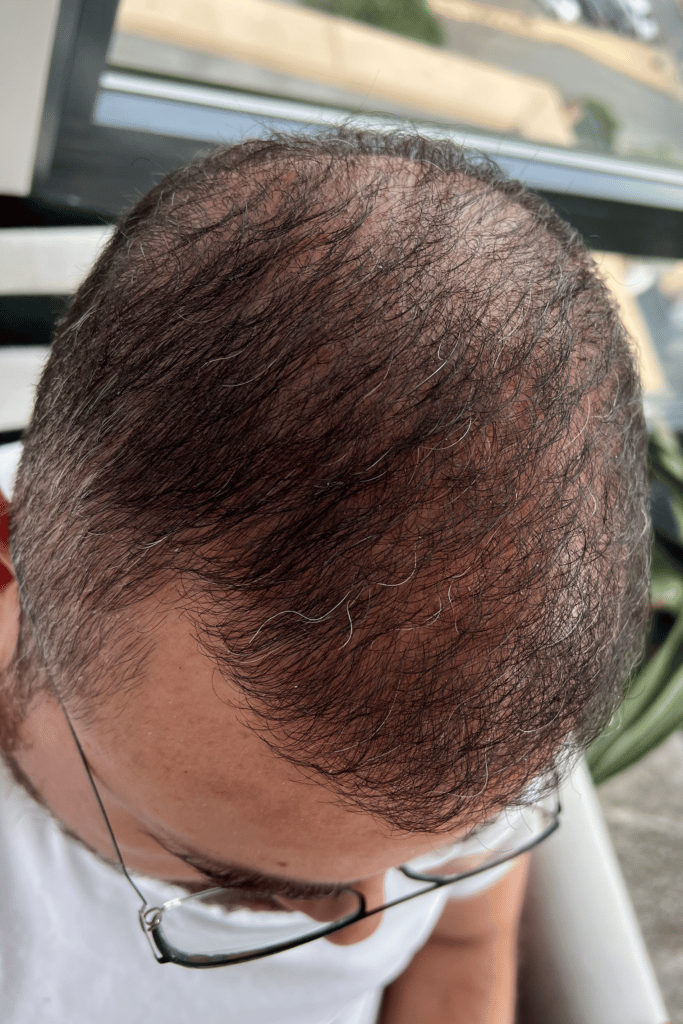 top of man's head after neograft hair restoration with fuller hair