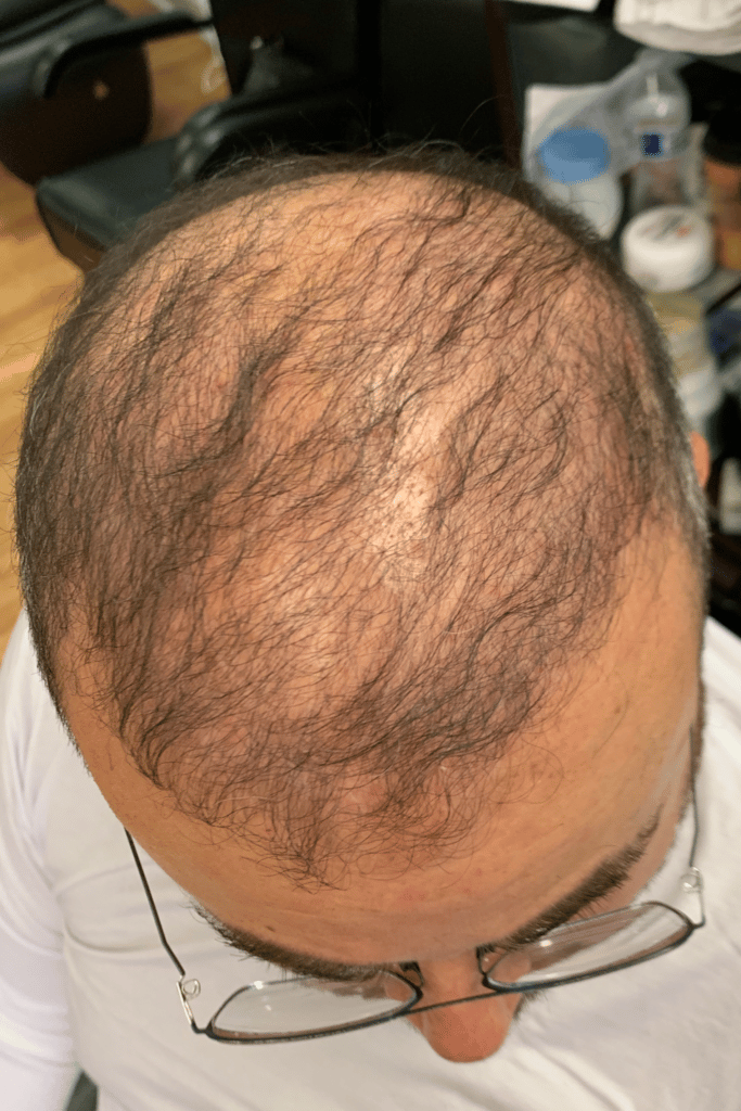 NeoGraft® in Washington . | Hair-Transplantation for Men