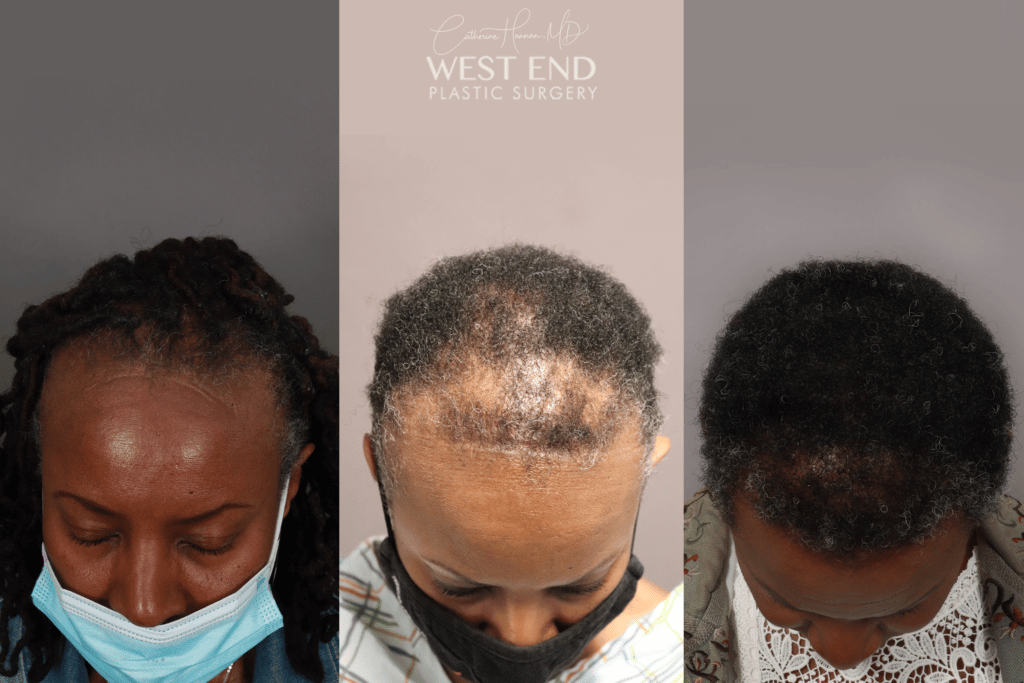 top of woman’s head before and after alopecia hair loss treatment