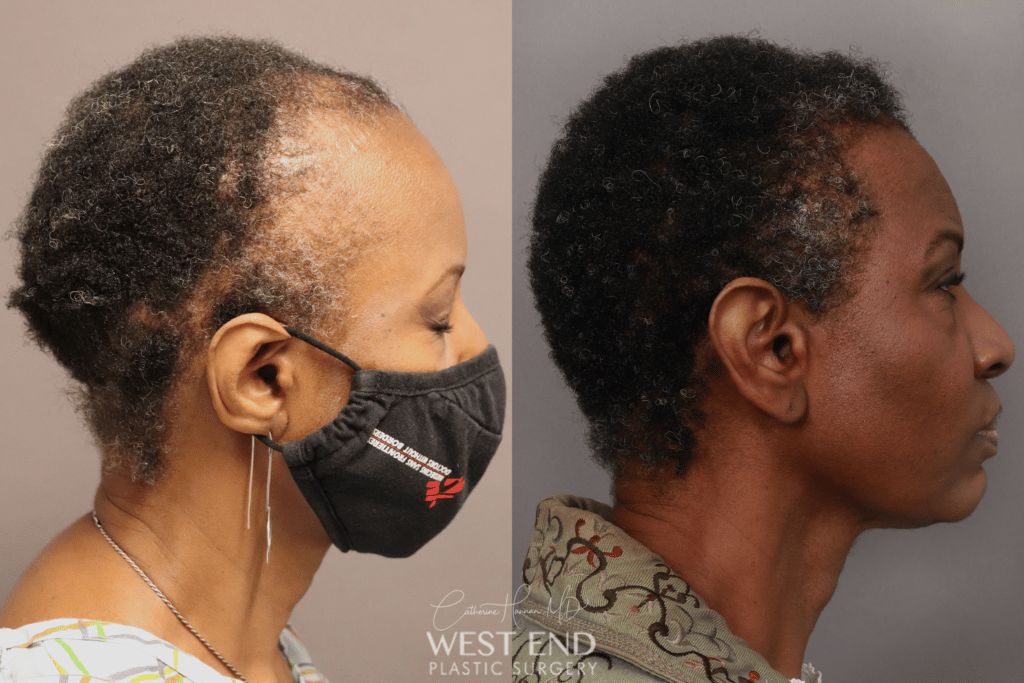 Female Hair Loss in Washington, DC | West End Hair Restoration