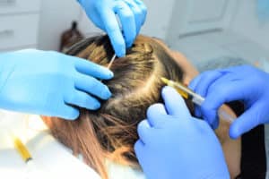 dermatologist injects the plasma into the scalp of the patient