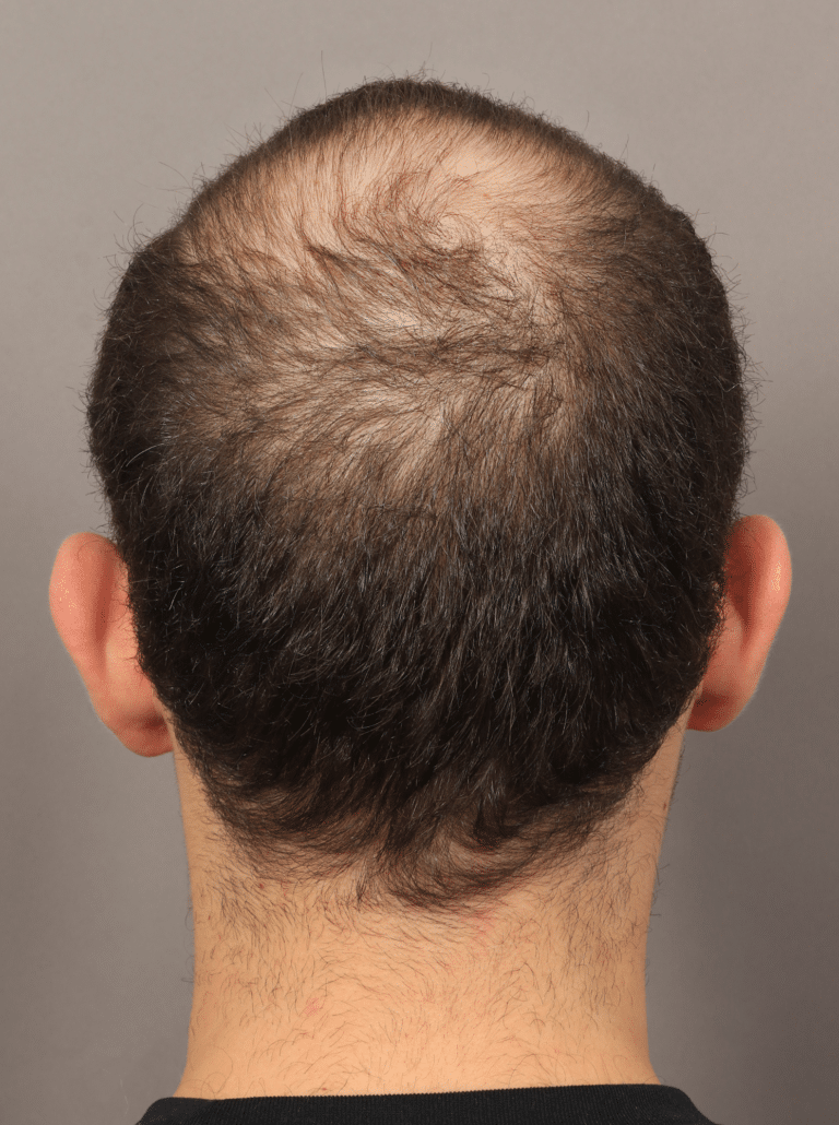 Before Image: Male NeoGraft - back