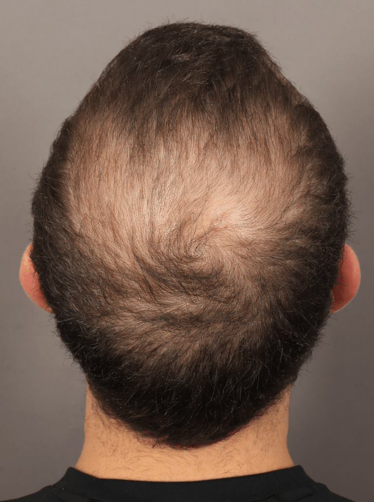 Before Image: Male NeoGraft - back