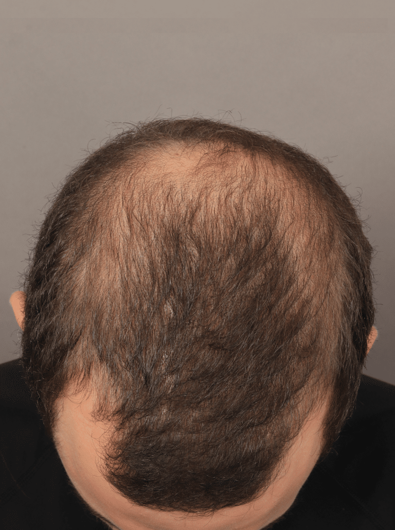 Before Image: Male NeoGraft - front