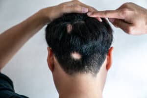 Back of man’s head showing patchy hair loss