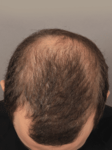 Before Image: Male NeoGraft (9 Months Post-op)