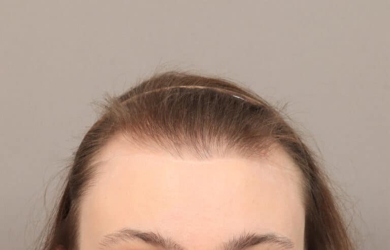 Before Image: Female NeoGraft (7 Months Post-Op) - front