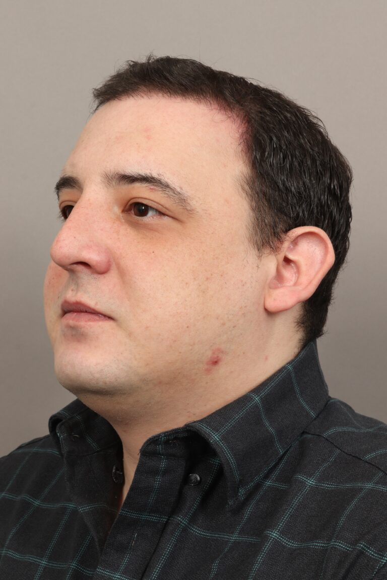 After Image: Male NeoGraft (5 Months Post-Op) - left-front-oblique