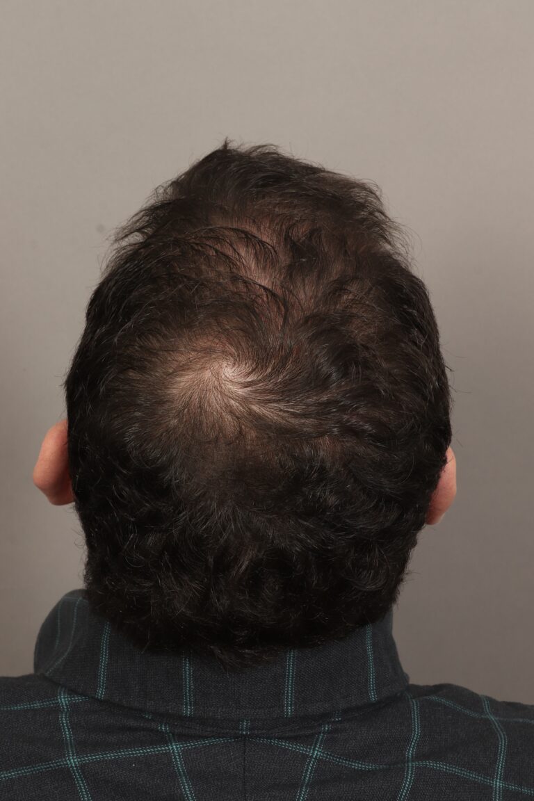 After Image: Male NeoGraft (5 Months Post-Op) - back
