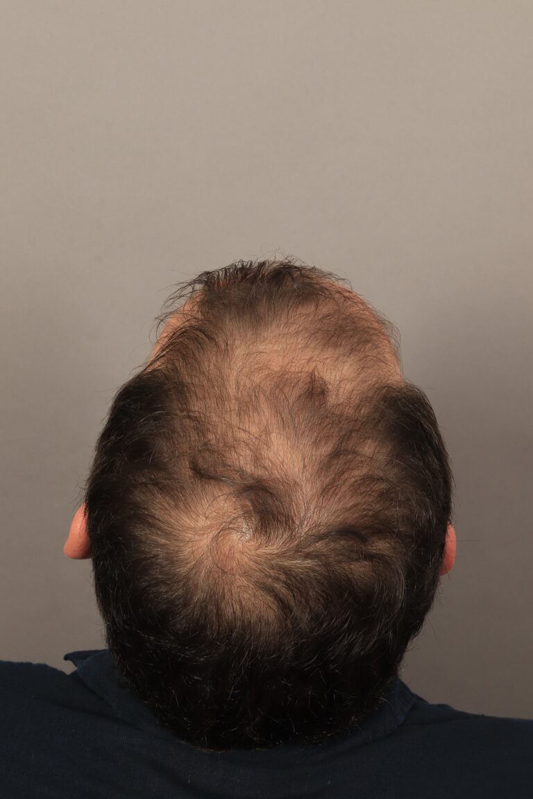 Before Image: Male NeoGraft (5 Months Post-Op) - back