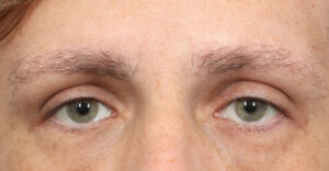 After Image: Male NeoGraft Eyebrows (4 Months Post-Op)