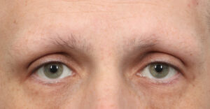 Before Image: Male NeoGraft Eyebrows (4 Months Post-Op)