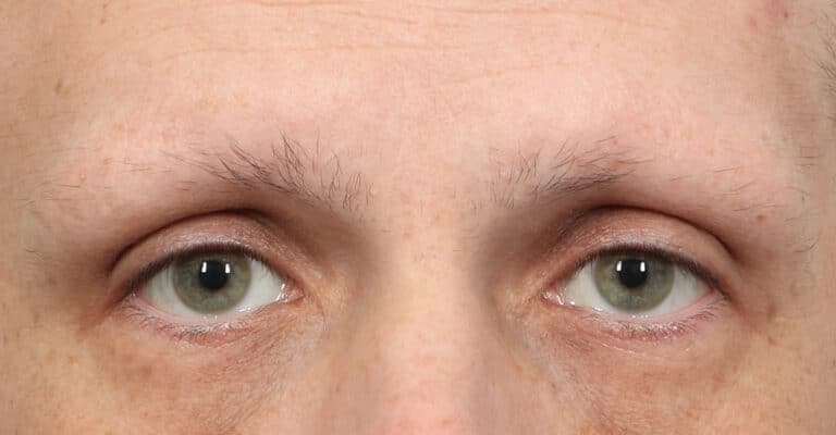 Before Image: Male NeoGraft Eyebrows (4 Months Post-Op) - front